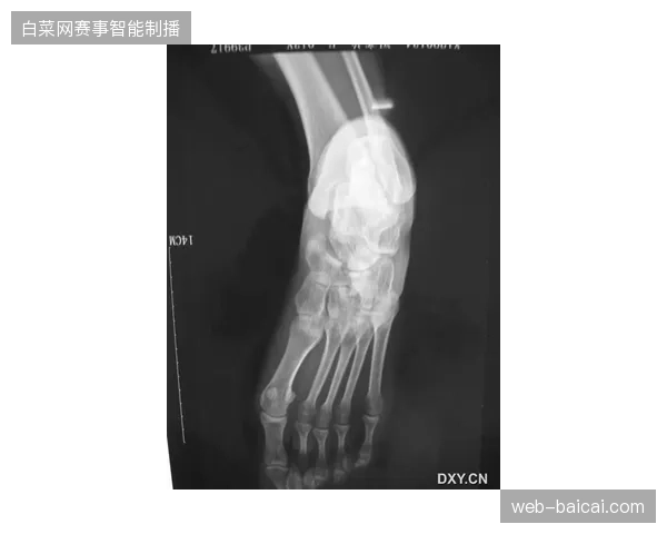 南野拓实因锁骨骨折手术影响备战，日本队前场攻击群面临多人状态调整问题